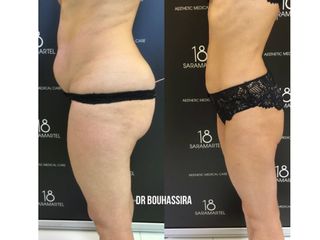 Avant après Liposuccion