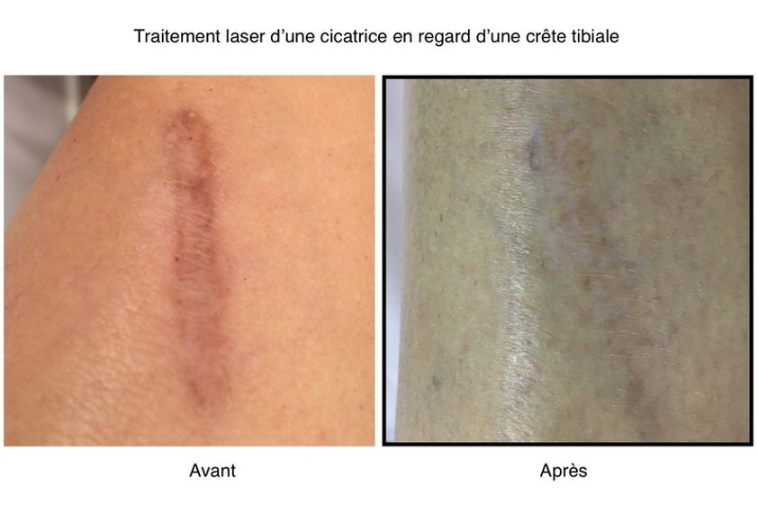 Traitement cicatrice avant et après - 636277