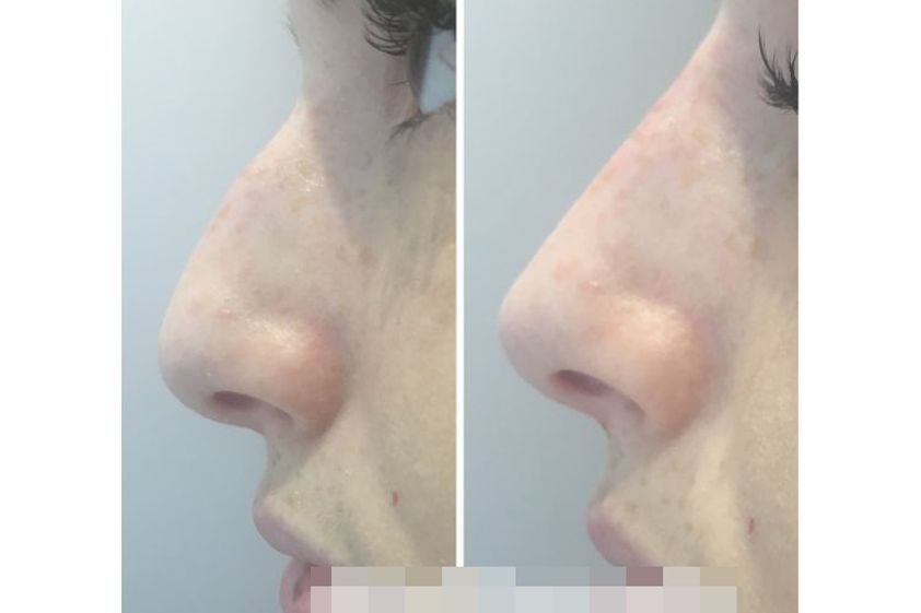 Rhinoplastie médicale avant et après - 646820