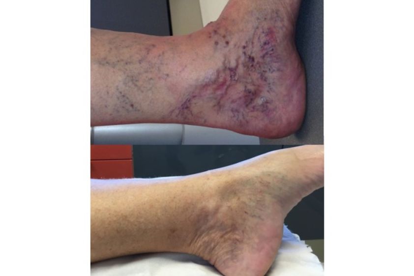 Varices avant et après - 633575
