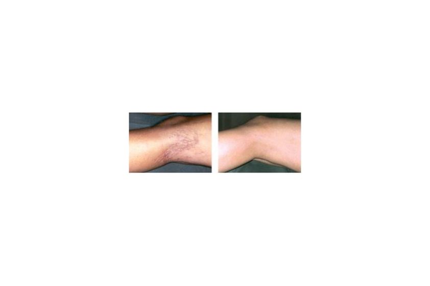 Varices avant et après - 633576
