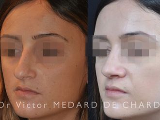 Rhinoplastie - 639692