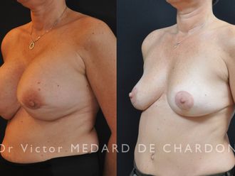 Implants mammaires avant et après - 645165