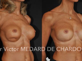 Chirurgie reconstructrice avant et après - 645175