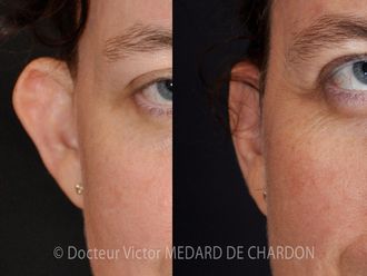 Otoplastie - 645438