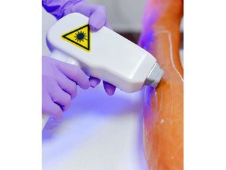 Épilation Laser - 639296