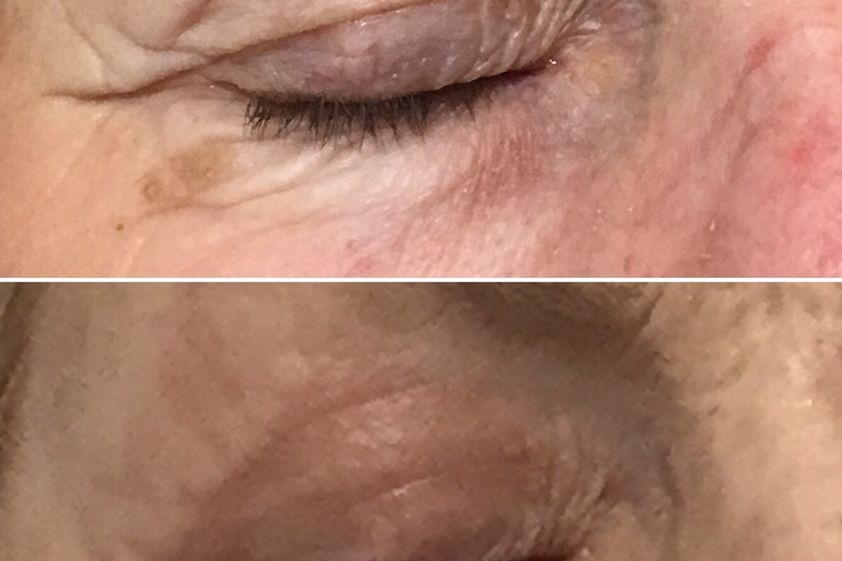 Laser dermatologique avant et après - 816038
