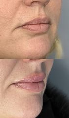 Augmentation des lèvres - Dr Catherine Molimard