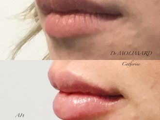 Augmentation des lèvres - 816041