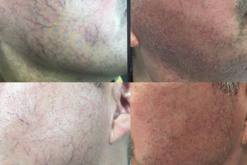 Varices avant et après - 816434