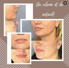 Augmentation des lèvres - Dr Catherine Molimard
