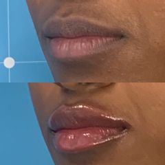 Russian Lips- Dr Molimard Catherine