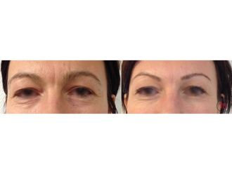 Botox - 742625
