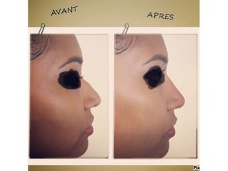 Rhinoplastie médicale - 742636