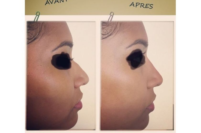 Rhinoplastie médicale avant et après - 742636