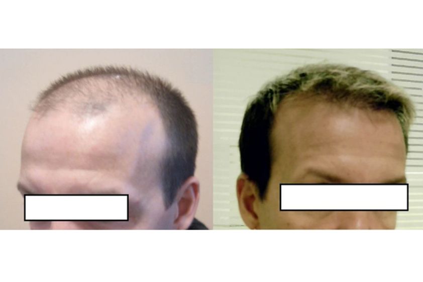 Greffe de cheveux avant et après - 530014