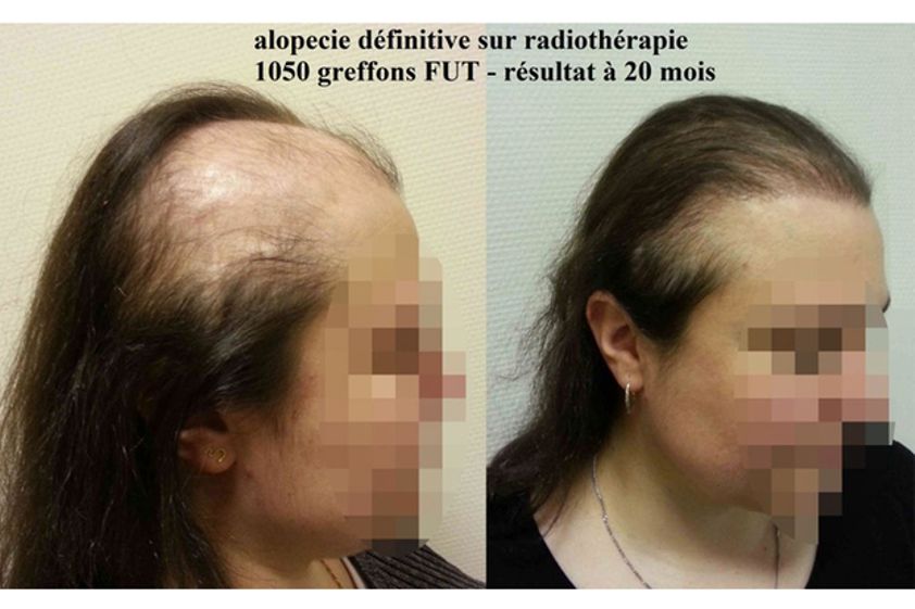 Greffe de cheveux avant et après - 530016
