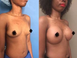 Augmentation mammaire - 607390