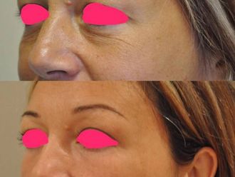 Blépharoplastie - 630000