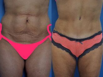 Abdominoplastie - 630001