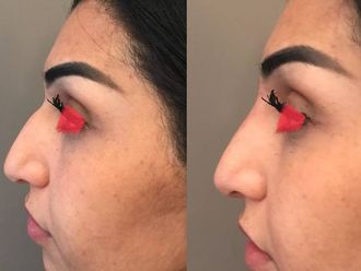 Rhinoplastie médicale - 630002