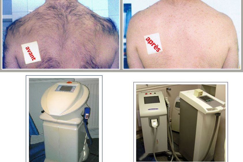 Épilation Laser avant et après - 497257