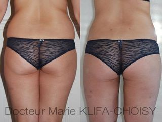 Avant après lipoaspiration