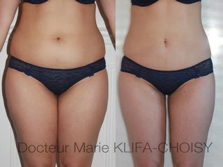Avant après Lipoaspiration du ventre et des cuisses