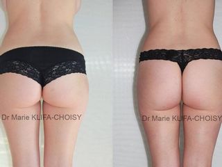 Avant après Lipoaspiration culotte de cheval
