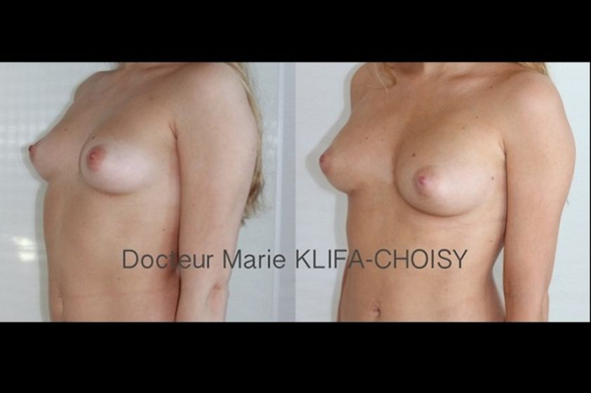 Lipofilling avant et après - 612435
