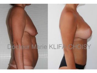Avant après protheses cure de ptose mammaire et abdominoplastie