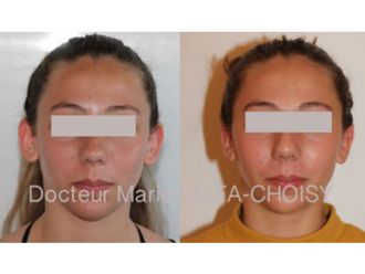 Otoplastie - 620456