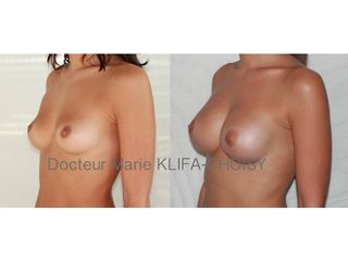 Avant après augmentation mammaire par protheses