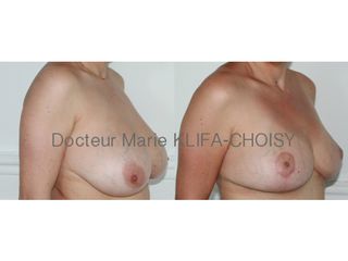 Avant après reduction mammaire