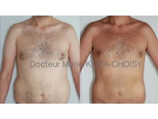Avant après lipoaspiration
