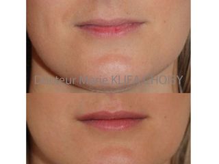 Avant après Augmentation du volume des lèvres par injection d'acide hyaluronique Dr Klifa Choisy