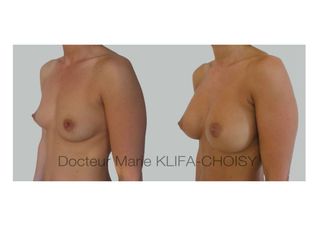 Avant après Augmentation des seins