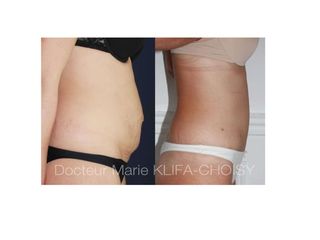 Avant après Abdominoplastie