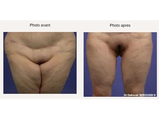 Avant après Lifting des cuisses