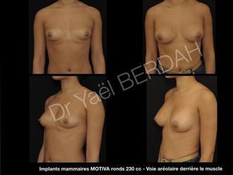 Implants mammaires avant et après - 614255