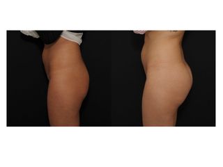Avant après Augmentation des fesses