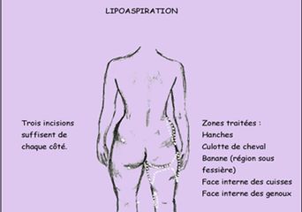 Lipoaspiration