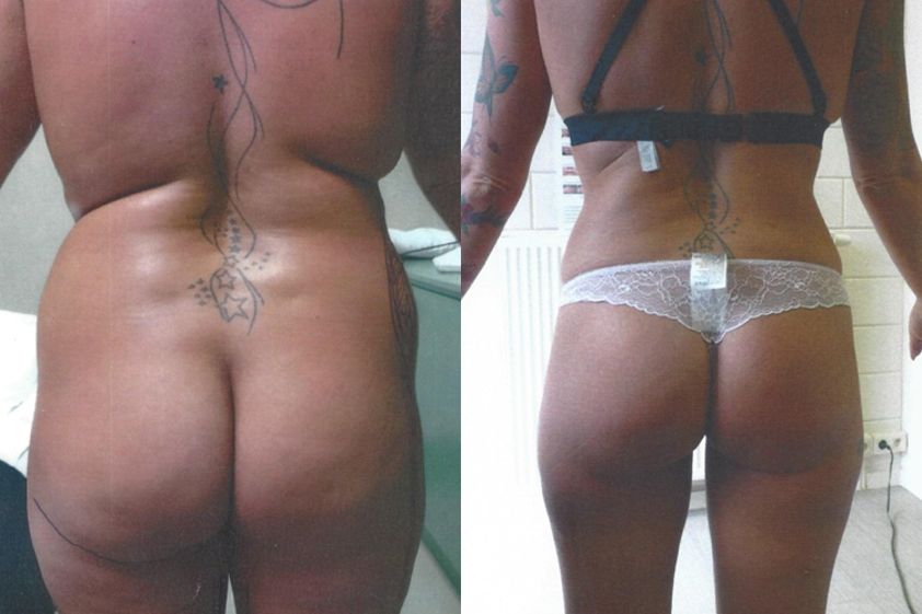 Liposuccion avant et après - 826211