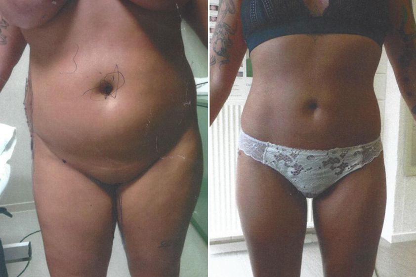 Liposuccion avant et après - 826213