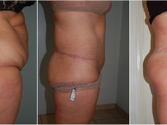 Bodylift avant et après - 826619