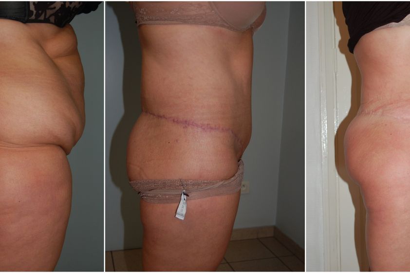 Bodylift avant et après - 826619