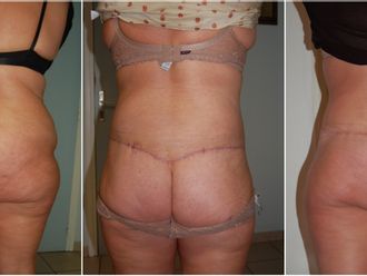 Bodylift avant et après - 826620