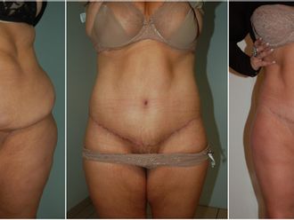 Bodylift avant et après - 826621