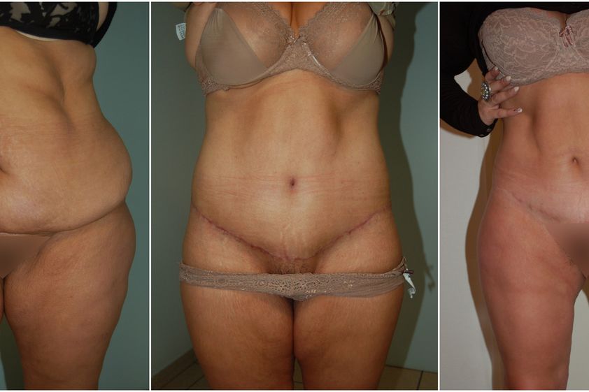 Bodylift avant et après - 826621