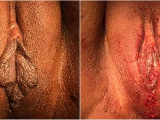 Vaginoplastie avant et après - 826623